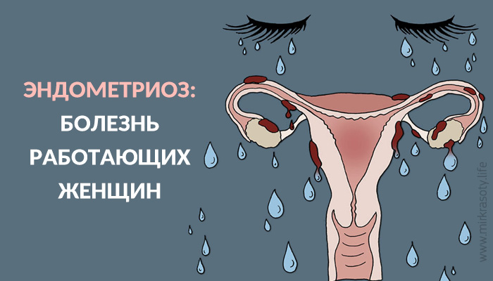 Эндометриоз — болезнь работающих женщин