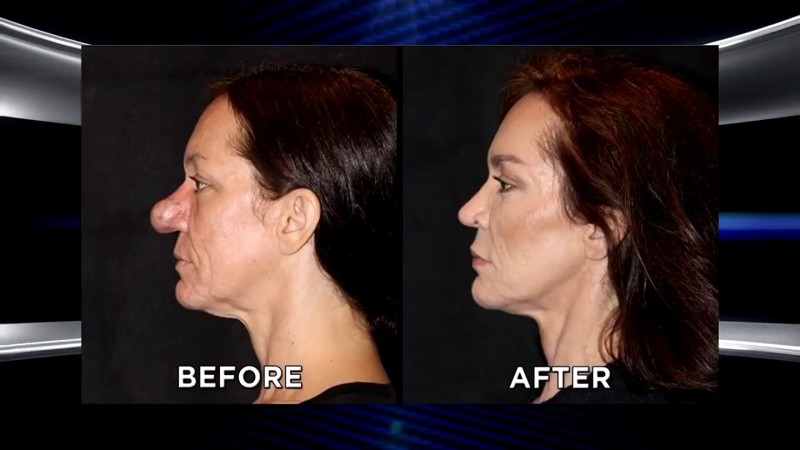 Из-за болезни нос этой женщины вырос до невероятных размеров