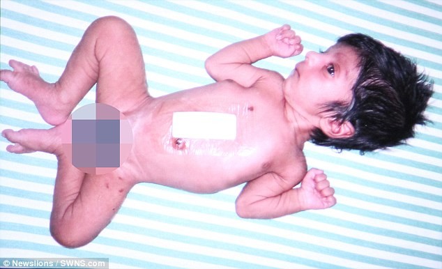  Шок: индийские врачи сделали операцию мальчику, родившемуся с четырьмя ногами!