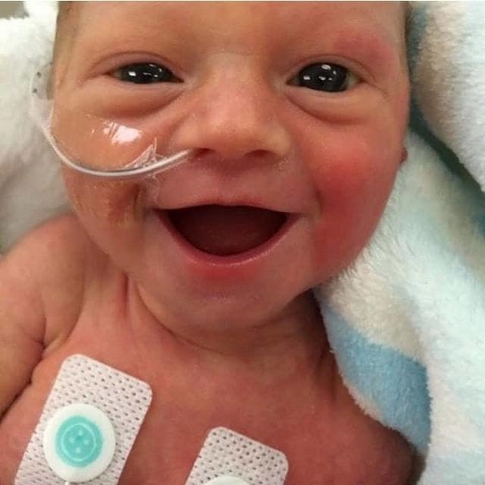 12 фото недоношенных малышей, которые счастливы просто потому, что живут.