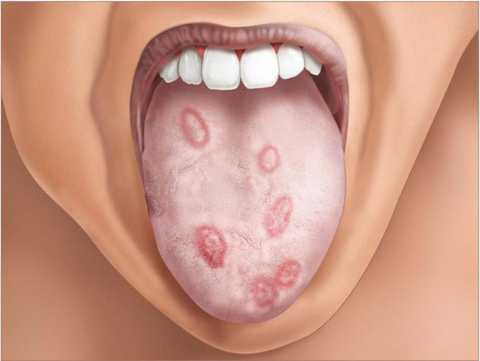 симптомы вторичного сифилиса во рту